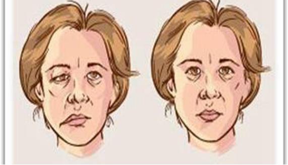 左眼面部痉挛怎么治疗,治疗面部痉挛哪家医院好