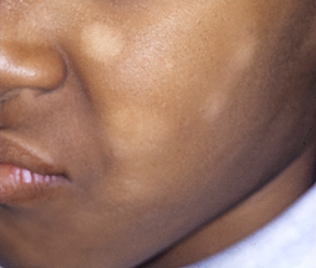 有什么白斑是不用治疗的,白斑怎样治疗才能消失呢