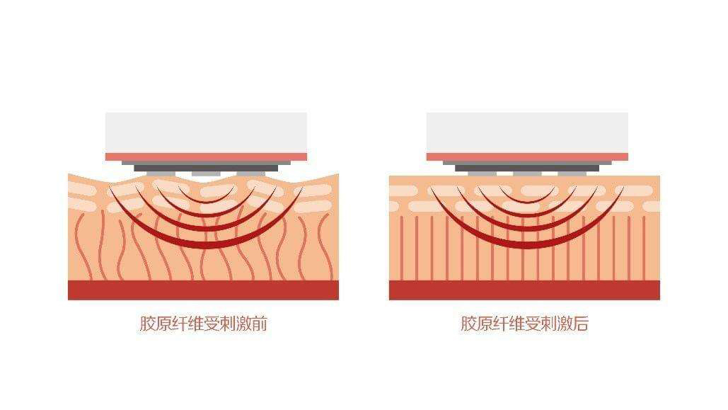 美容仪凝胶的作用,美容仪凝胶可以用平替吗