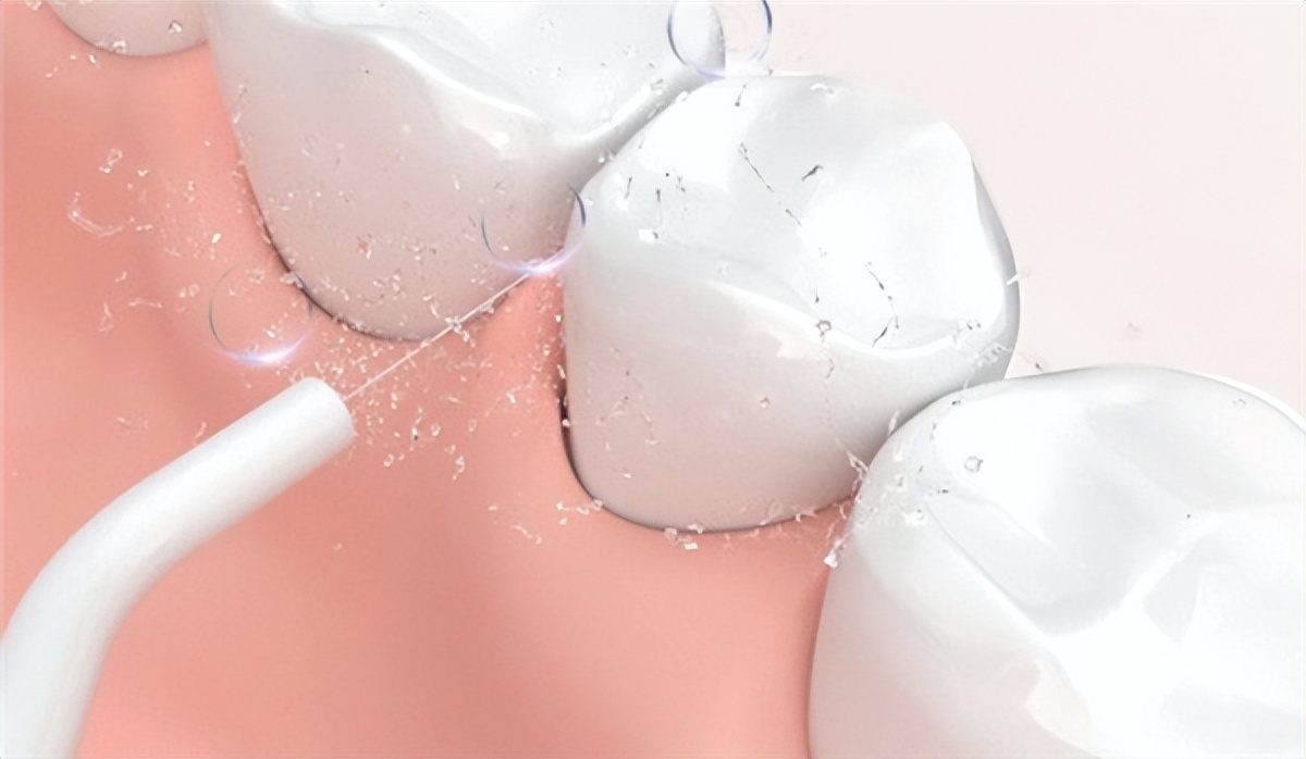 用冲牙器牙缝会变大吗,使用冲牙器会让牙缝变大吗