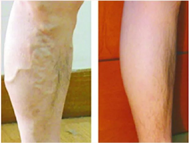 静脉曲张的福音！下肢静脉腔内微波消融闭合术，效果到底怎么样？