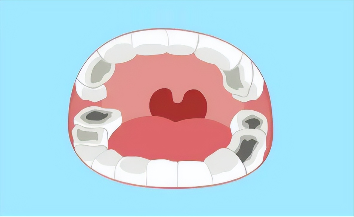 儿童乳牙龋齿有必要做根管吗,育儿小知识牙齿口腔的清洁