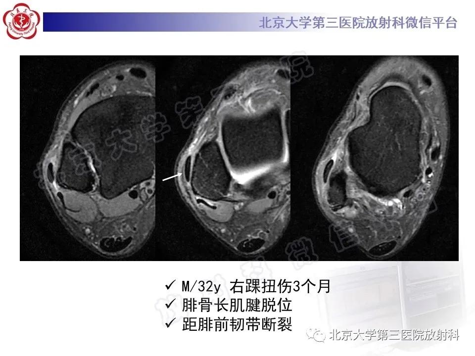 好文分享续集,腓骨肌腱脱位手术价格