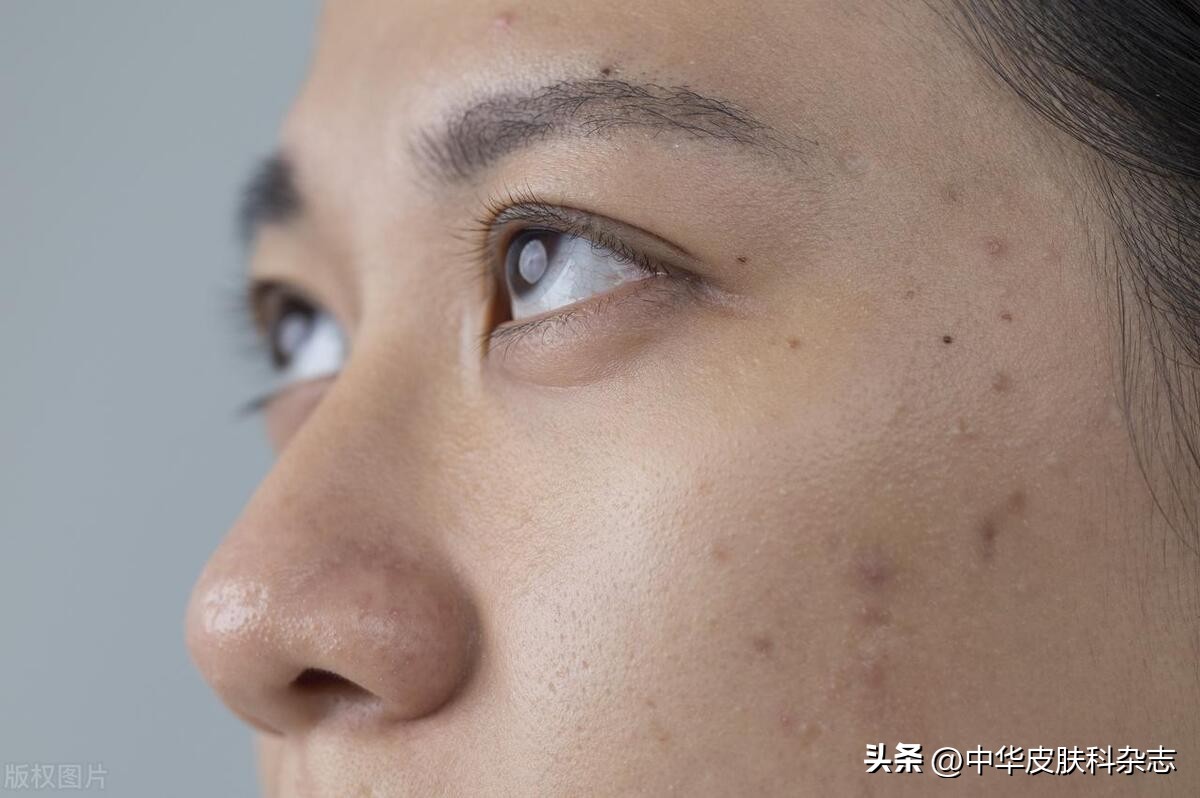 眼眶边上有很多小凸起,眼眶周围脂肪粒怎样清除