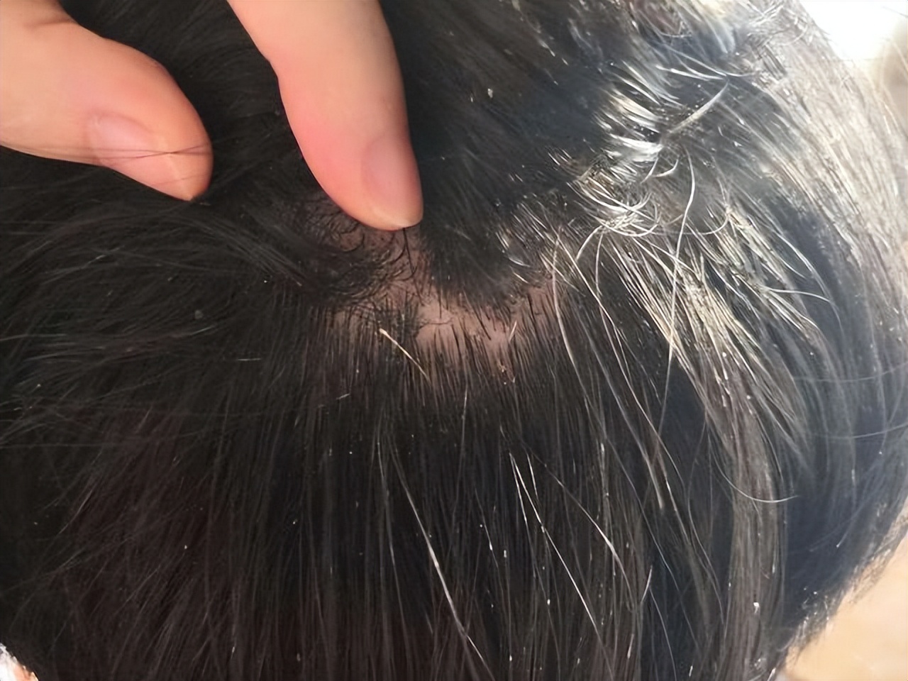 头皮上经常长疙瘩和脓包怎样治疗,头皮长疙瘩和脓包的常见原因