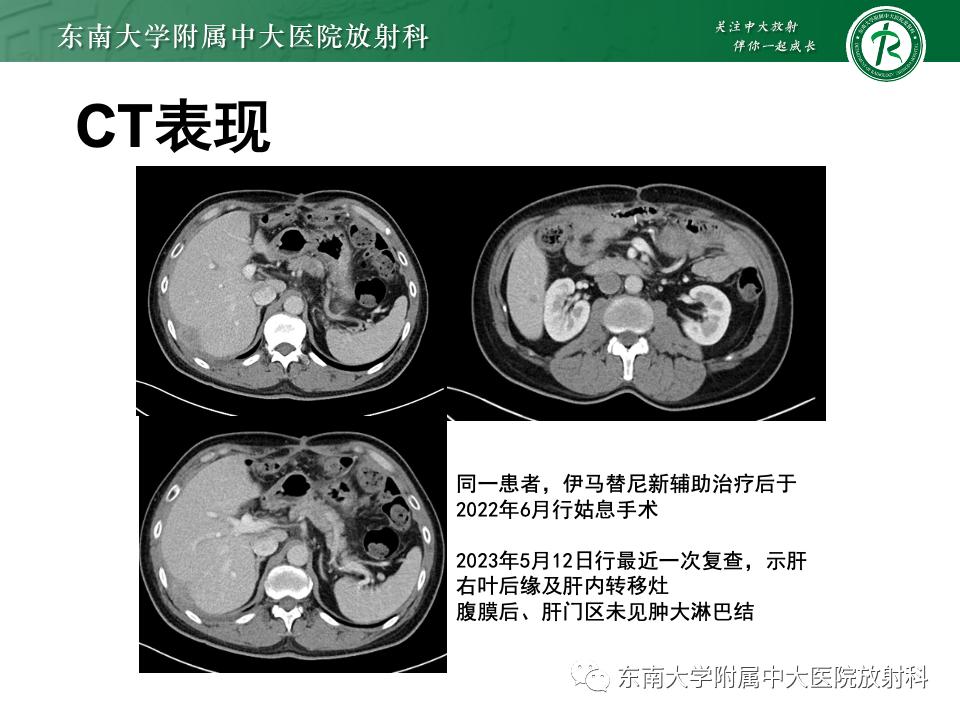 小肠间质瘤最新治疗中药方,小肠间质瘤基因检测