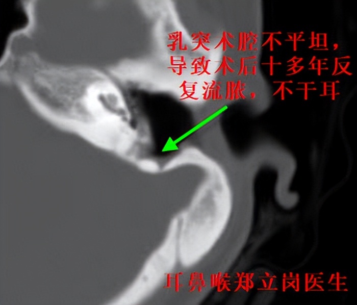 中耳炎手术后一直流脓怎么办,中耳炎术后复发吃什么药