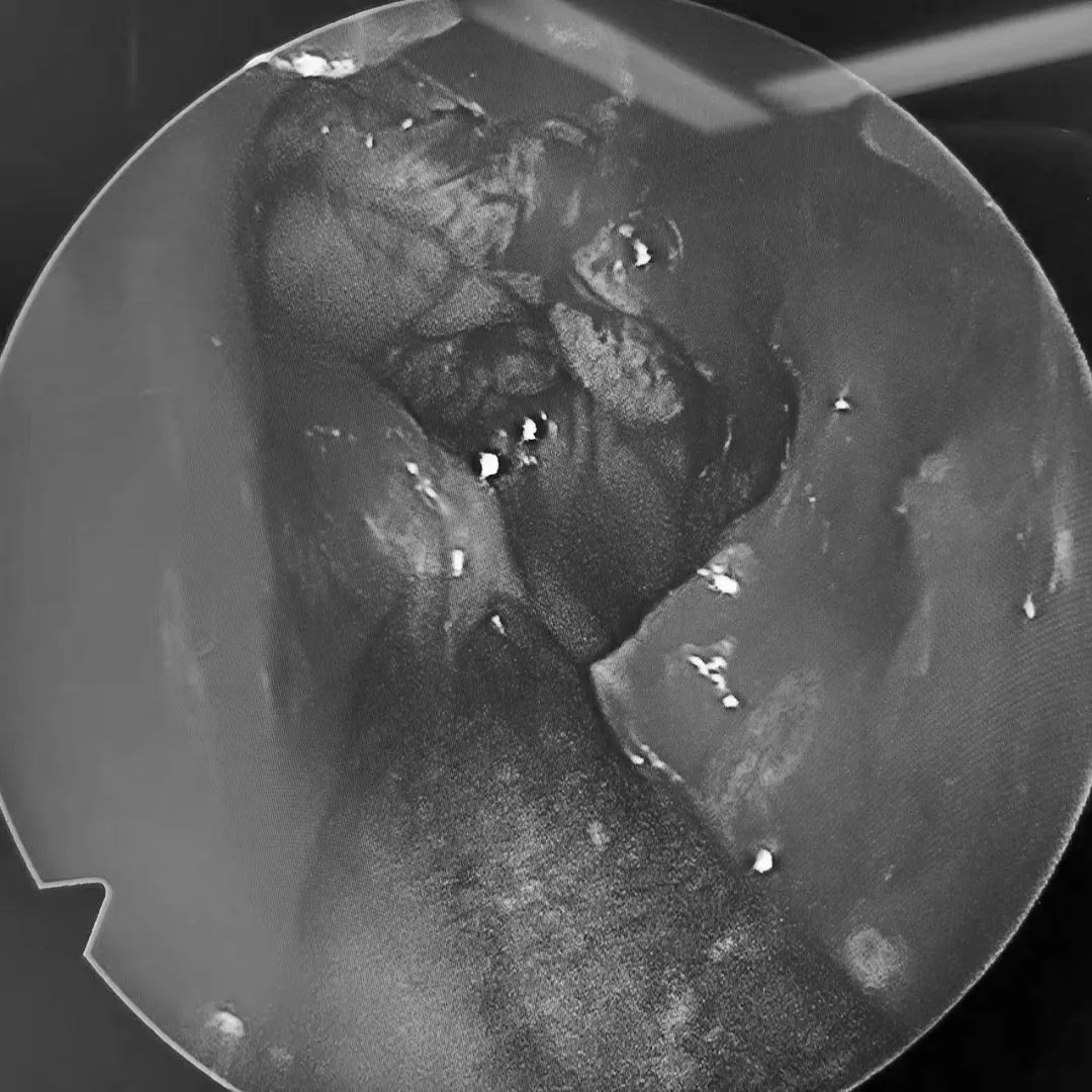 女子牙疼一周,女子牙痛用止痛药