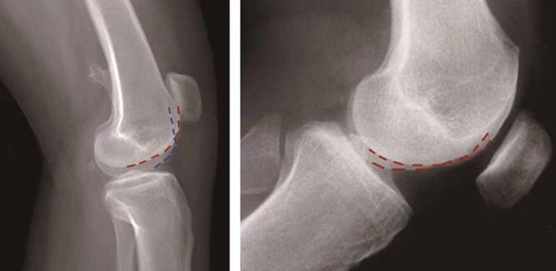 髌骨骨折评估,髌骨上下滑动评估什么内容