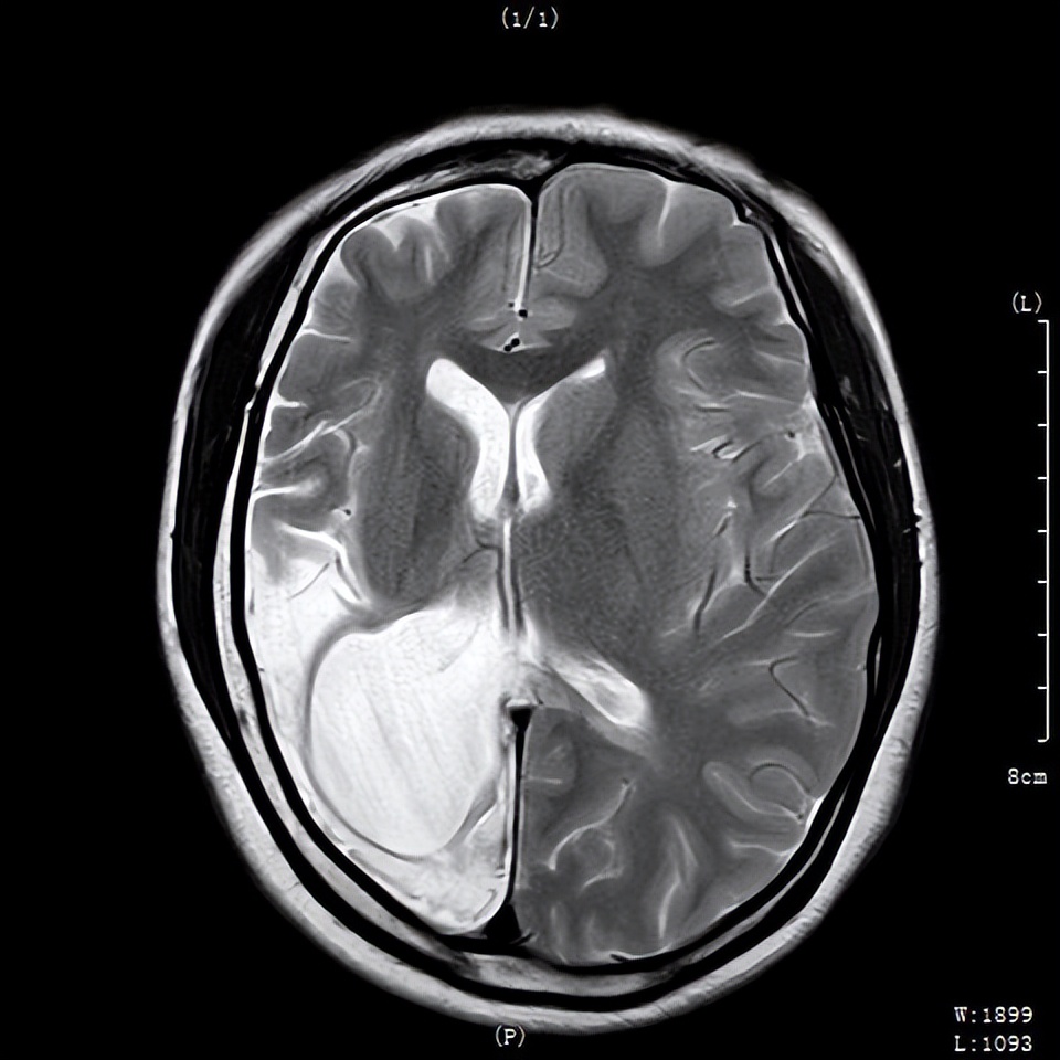 少女抗癫痫6年后终于迎来康复，顺利结婚生子，重获生命的美好