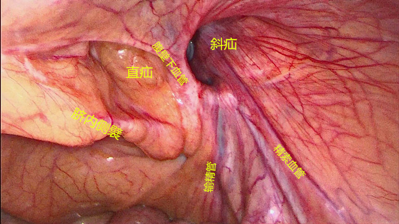 gilbert综合征的病例,gilbert综合征文献