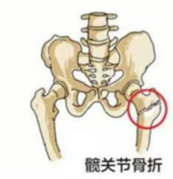 骨质疏松性骨折最常见的部位,发生骨质疏松骨折最常见的部位
