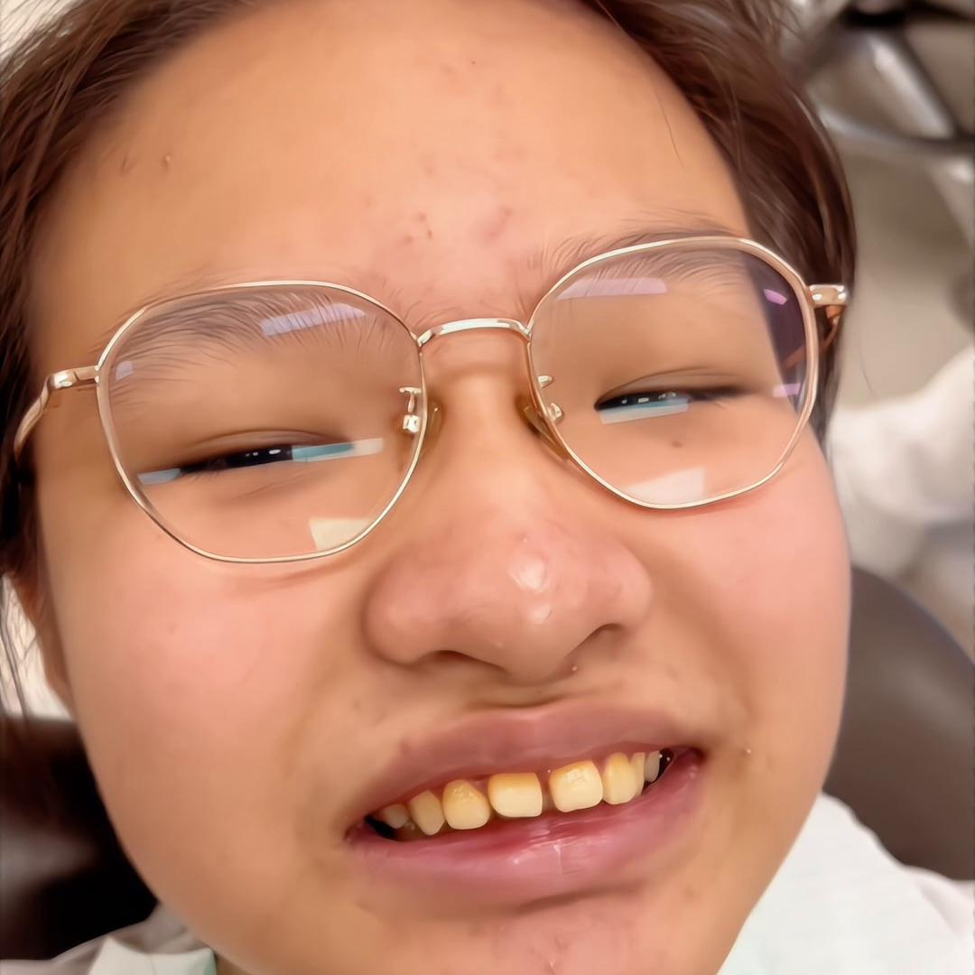 牙齿矫正龅牙拔牙全过程,矫正牙齿开颌拔牙的全部过程