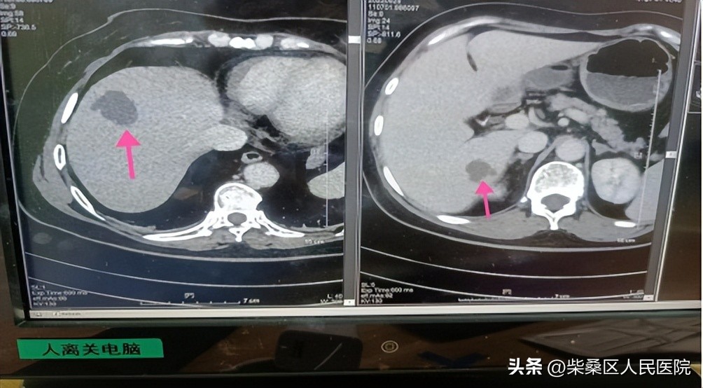 肝脓肿中西医结合治疗,肝脓肿淄博哪家治疗最好