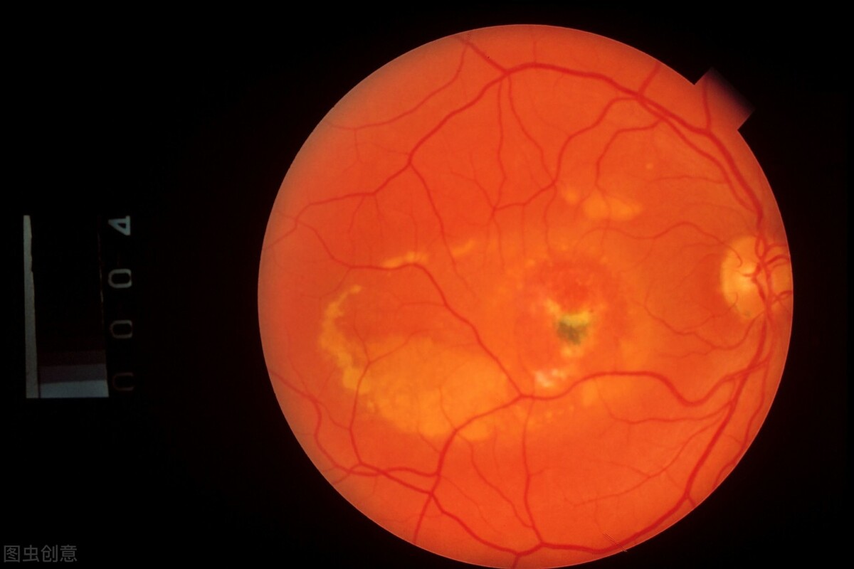 中医能不能治疗视网膜色素变性？