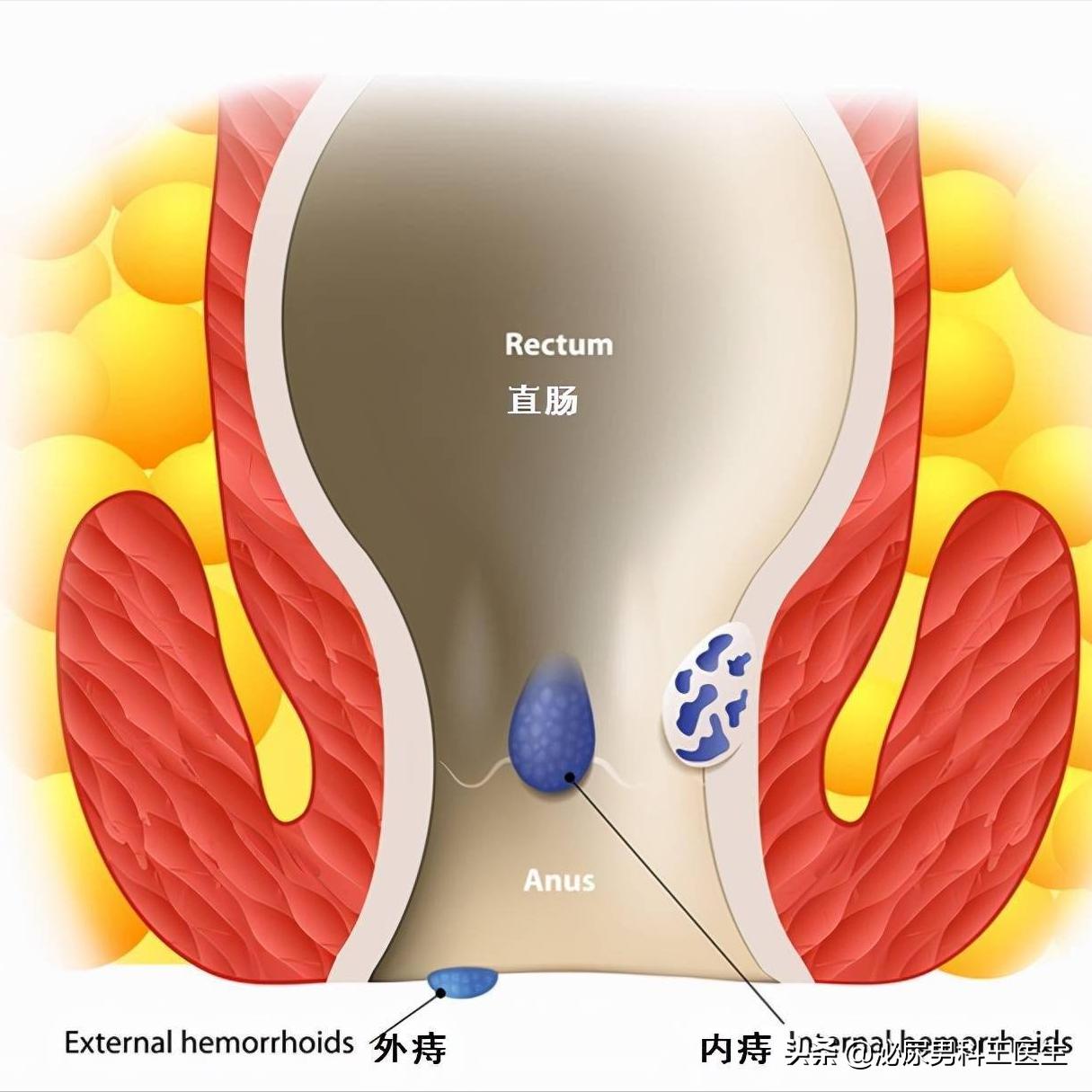 肛门潮湿发痒是什么病,肛门潮湿瘙痒是什么病怎样治愈