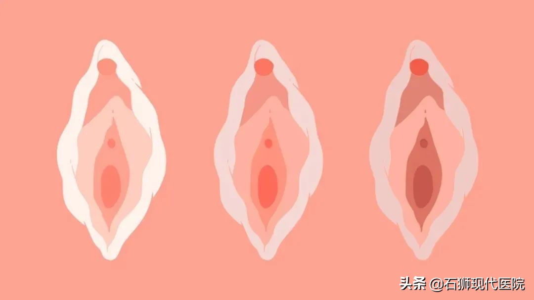 “快看她尿裤子了！”3D生物束带紧缩术帮你解决这些“社死瞬间”