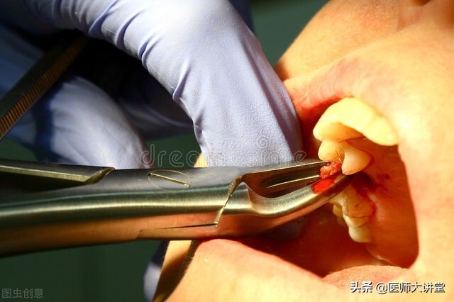 拔牙导致的死亡概率,拔牙事件真实案例