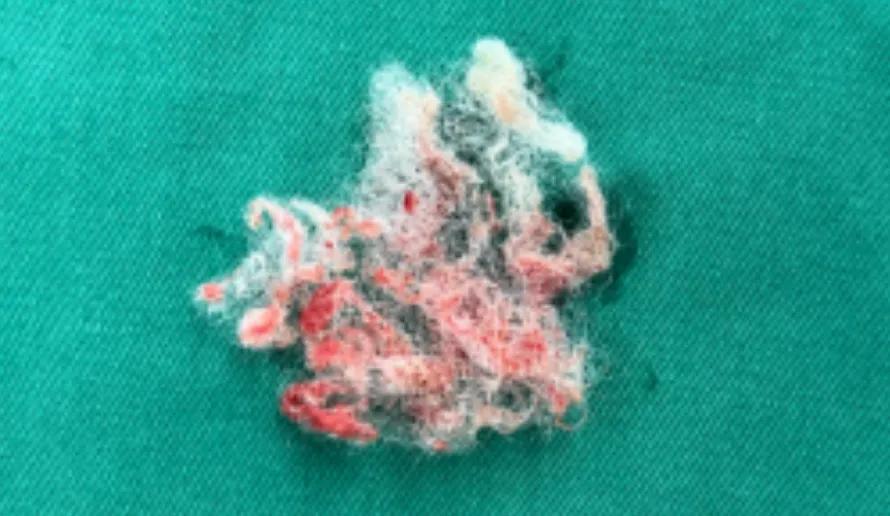 6岁女童隐私部位出血1个月，原因万万没想到，家有女娃要注意了！