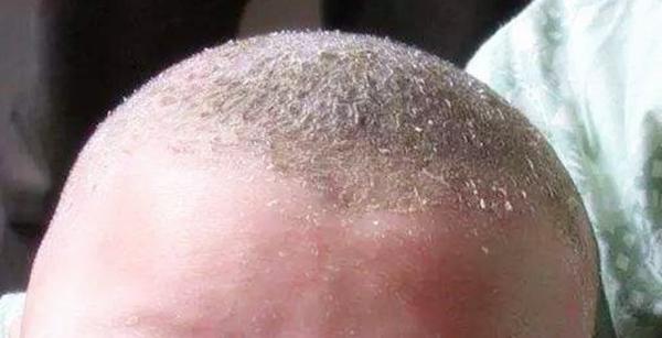 宝宝乳痂用手抠了有啥影响,坑娃的行为