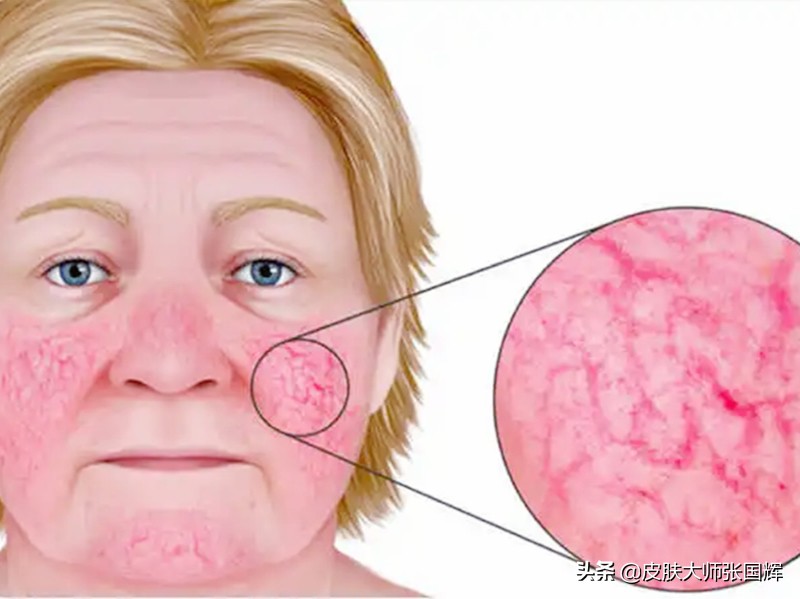 面部玫瑰痤疮平时要注意什么,面部玫瑰痤疮治疗方法