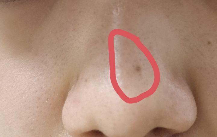 黑头没有弄出来就封口了怎么办,贴黑头贴导致毛孔变大怎么办