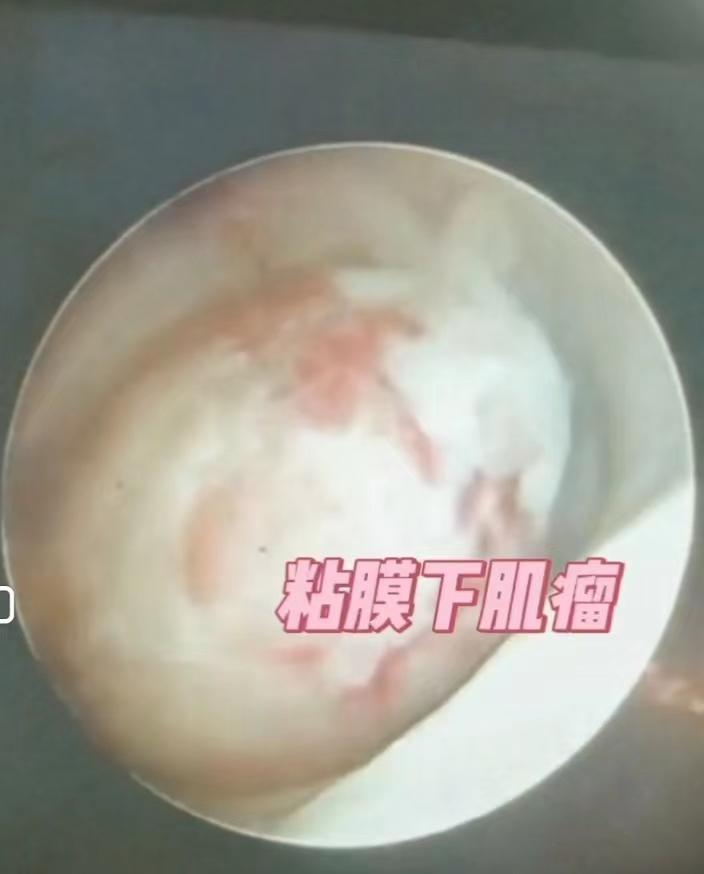 株洲市中心医院妇科成功为患者实施子宫肌瘤手术还保住其处女膜