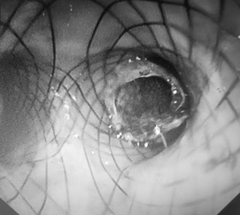 41年来首例!男子一咳就喷饭竟是食管、气管互通!医生胃镜、气管镜双镜齐下解罕见难题