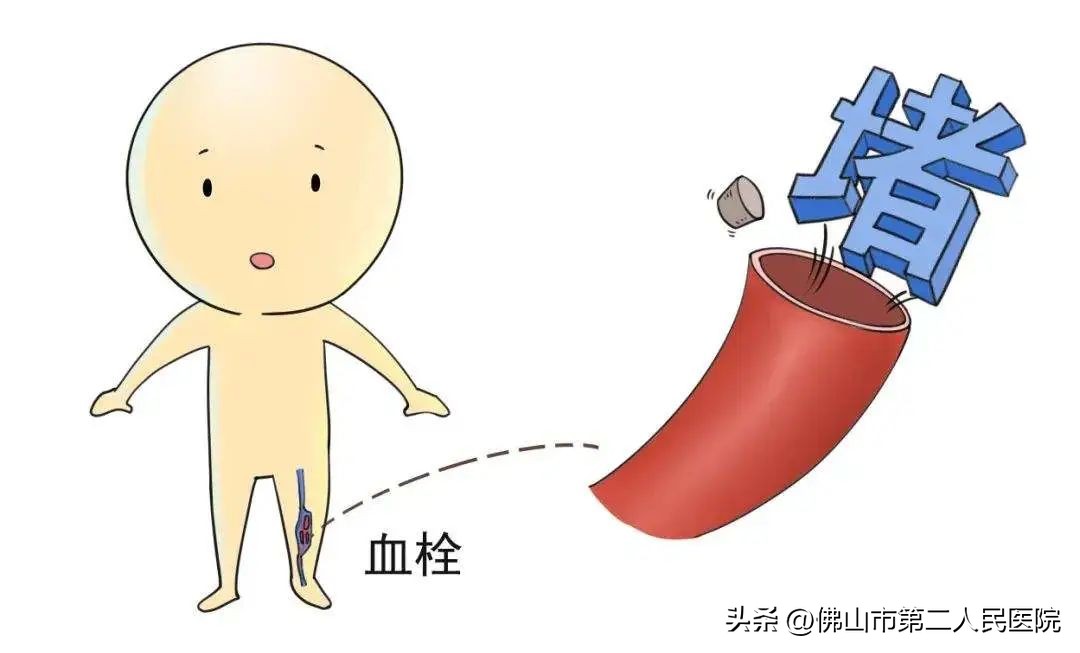 轻型肺动脉栓塞,隐形的杀手免费完整版