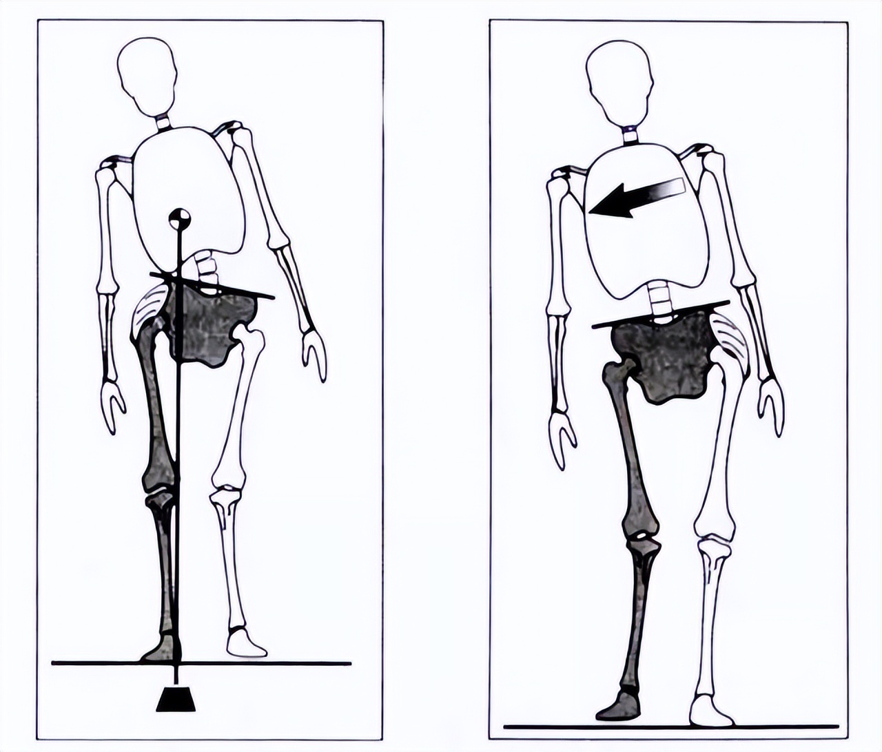 走路像鸭子臀中肌问题,走路左右摇摆像鸭子一样