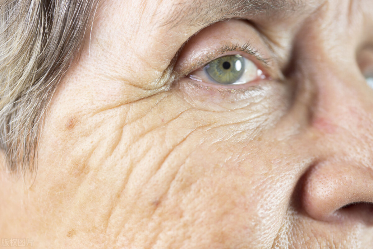 老年斑用哪种药膏能祛斑,牙膏涂在老年斑上可以祛斑吗