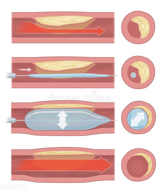 700块的心脏支架和20000块的药物球囊，哪个更香？医生：别误解了