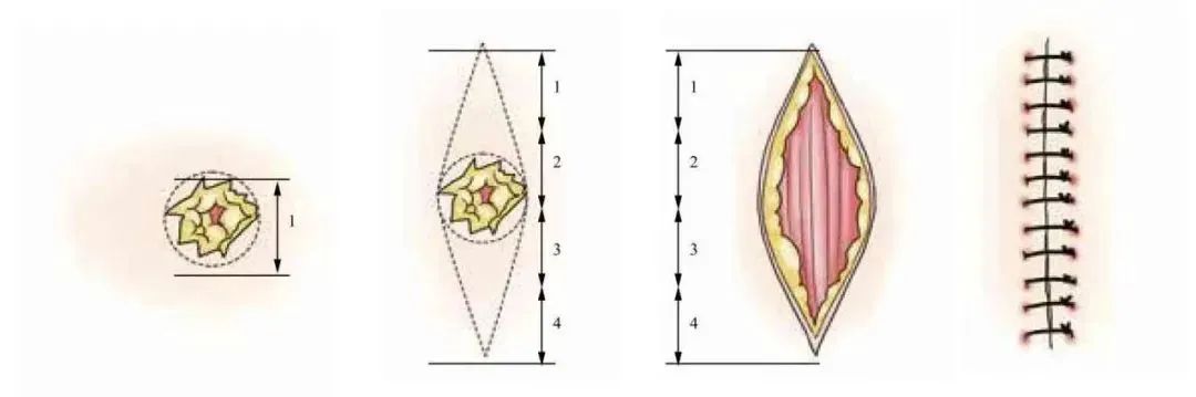 3分钟get:真正的外科缝合秘籍