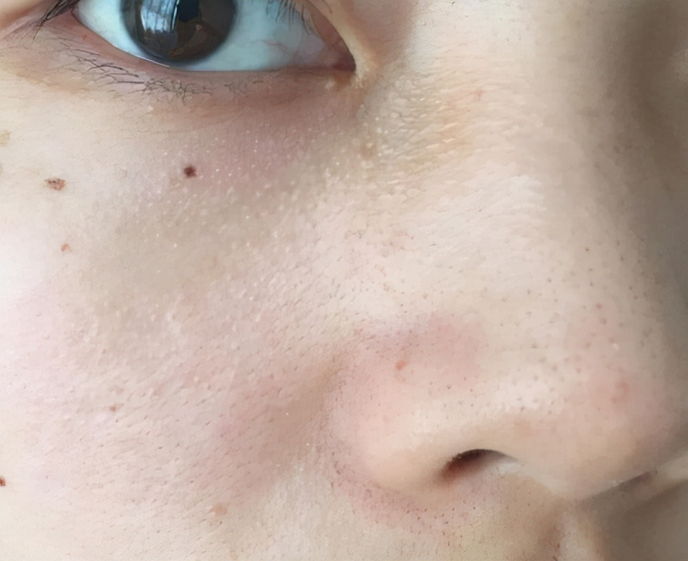 鼻子上挤出来的白色絮状是什么,鼻子挤压出现的白色条状物