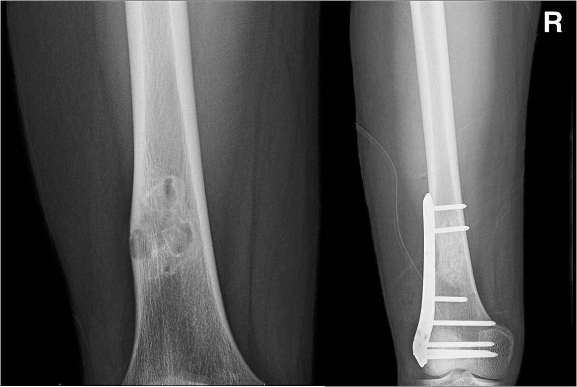 富血小板血浆因子作用,富血小板血浆治疗的目的和意义