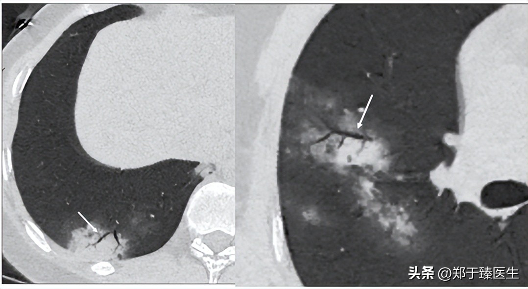 新冠病毒是如何损坏肺功能的,新冠病毒引起的肺部炎症怎么办