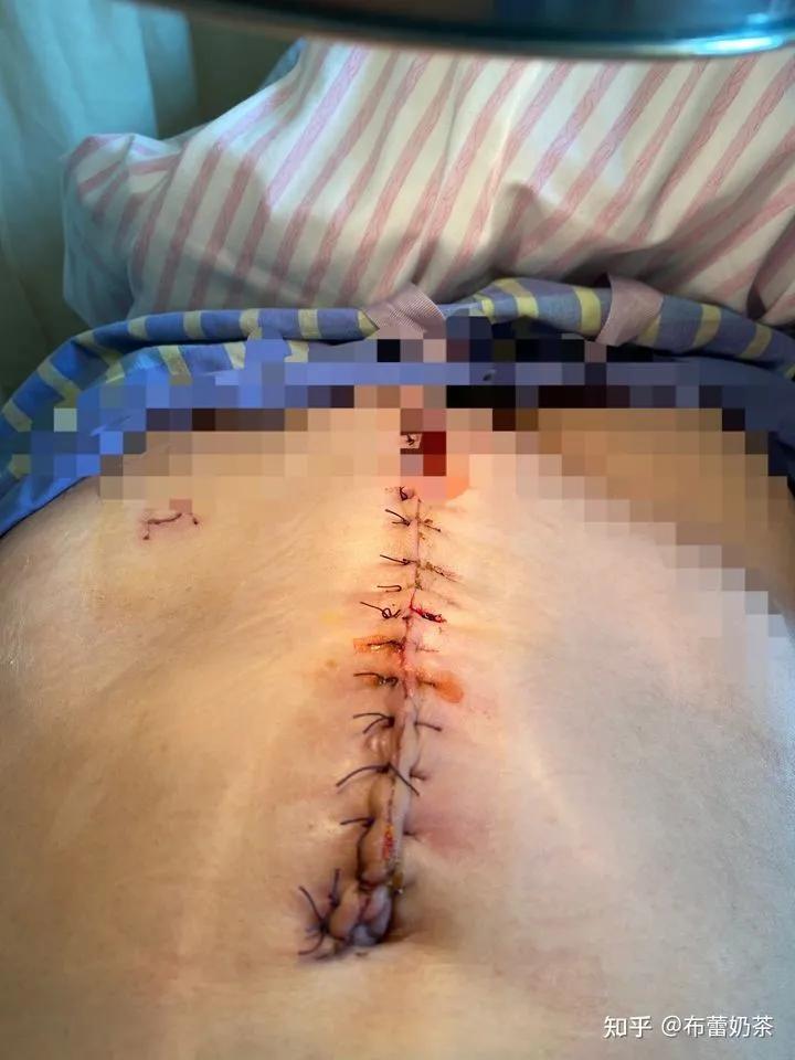 治愈的故事视频,一个癌症患者的康复故事在线阅读