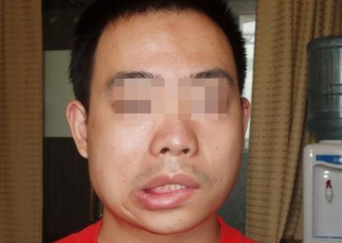 表情不受管理怎么办,表情不受控制是什么病