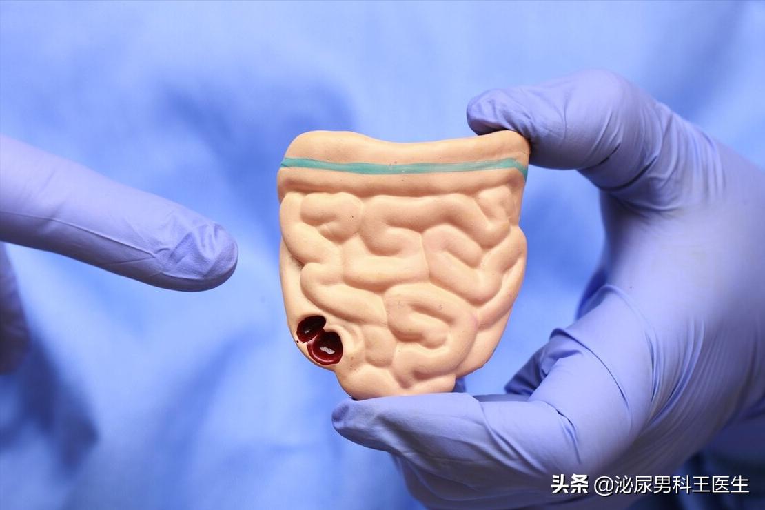 直肠癌早期身体发出3个救命信号,直肠癌症状是先下坠还是便血