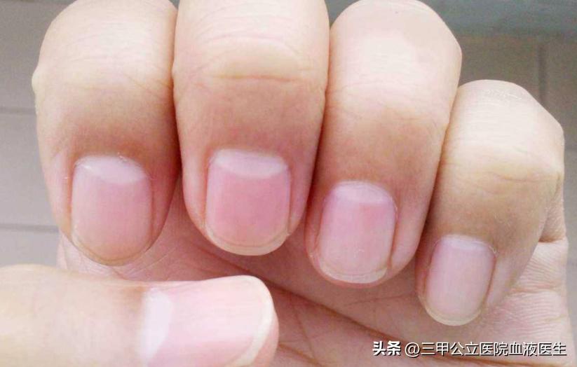 手指甲出现横纹预示身体怎样,手指甲有凹凸竖纹正常生理现象