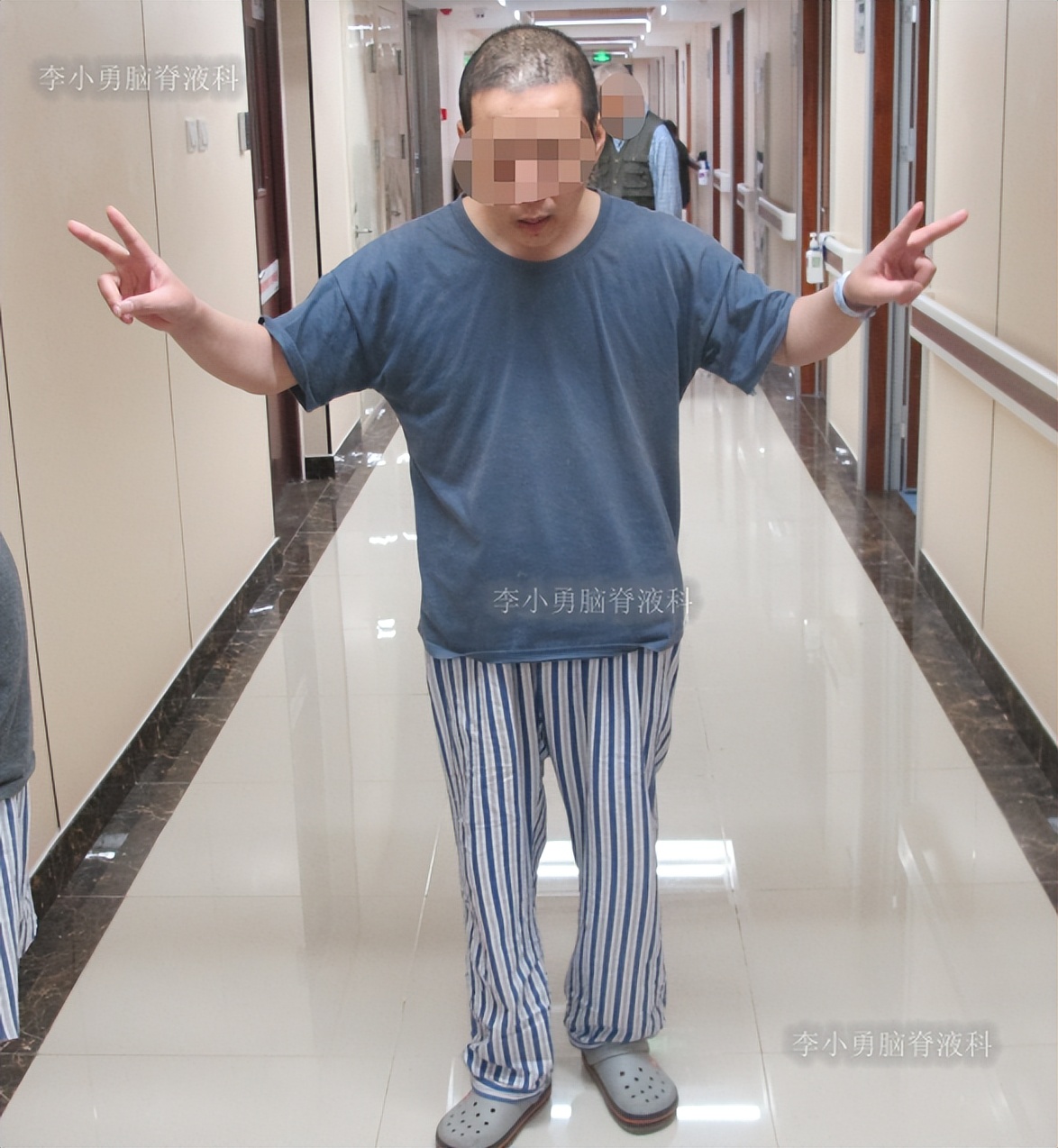 脑积水三脑室造瘘多久能恢复,脑囊虫手术后脑积水