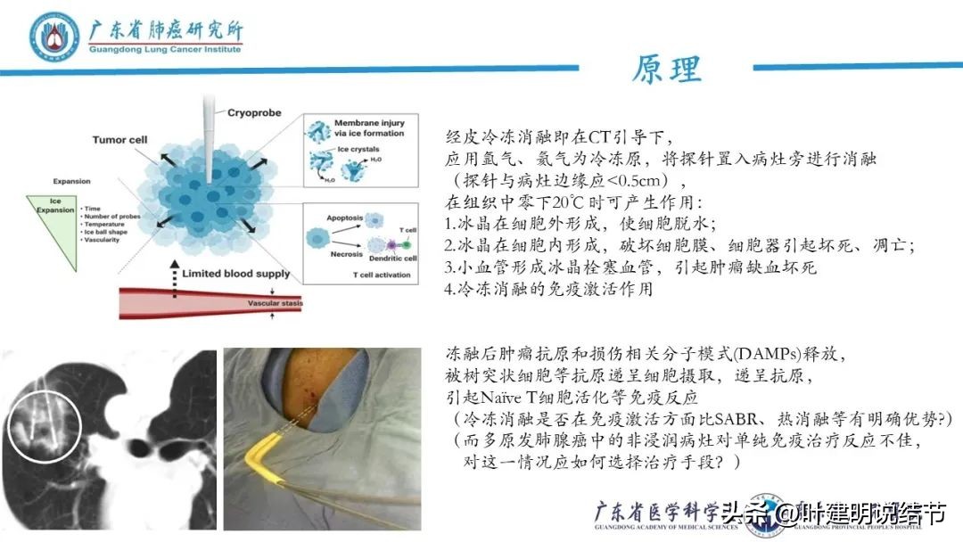 一文剖析肺结节疑癌心理,肺结节防治理念讲座
