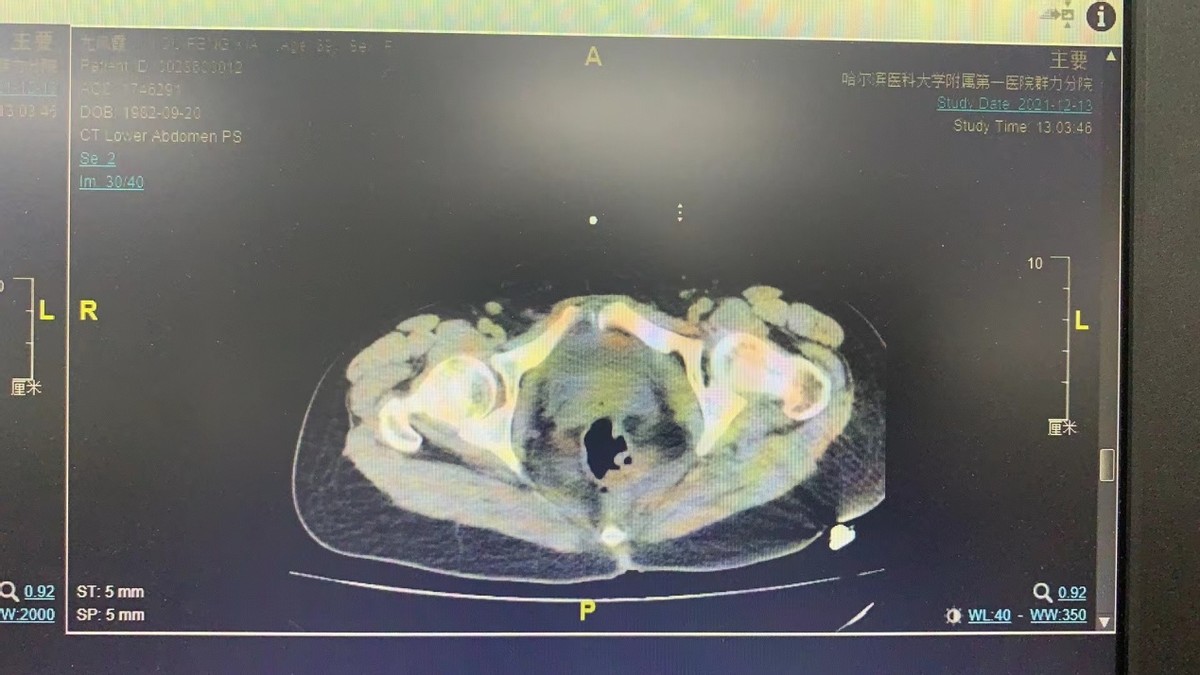 哈医大一院妇科住院部,哈医大一院妇科炎症