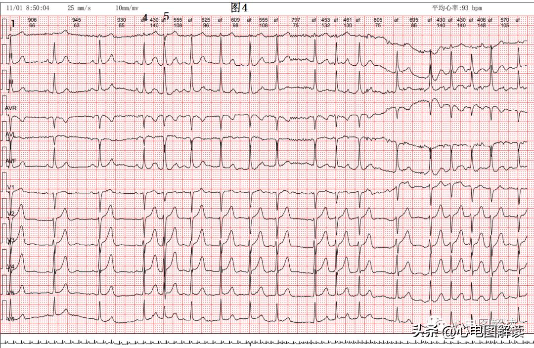 房性早搏和房颤会同时存在吗,频发房早会演变成房颤吗