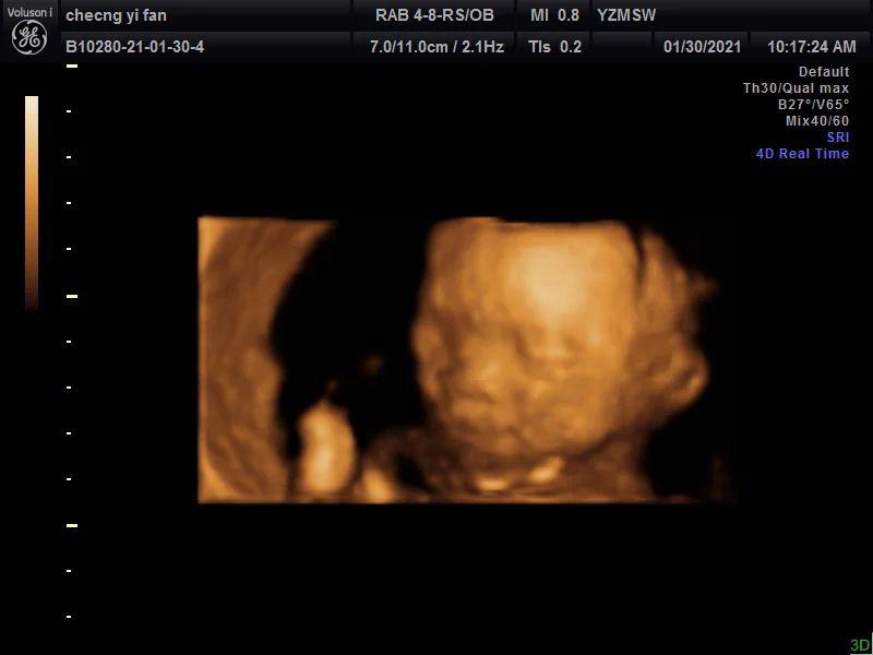 23周做了四维28周还需要再做吗,孕23周四维查出问题还能留吗