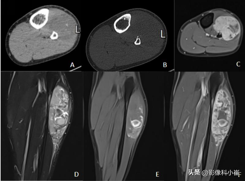 滑膜肉瘤影像学检查方法,骨肉瘤的影像报告模板