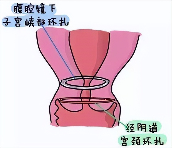 子宫机能不全做环扎术能保胎吗,宫颈机能不全适合哪种避孕环