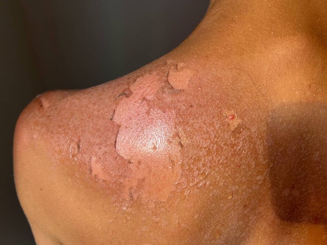 军训晒伤脸脱皮怎么办,军训会把头皮被晒伤吗