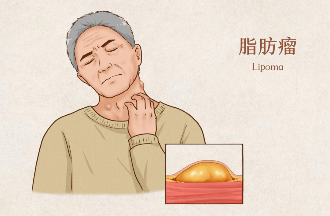 长出小肉粒怎么回事要涂什么,长出多余的肉疙瘩