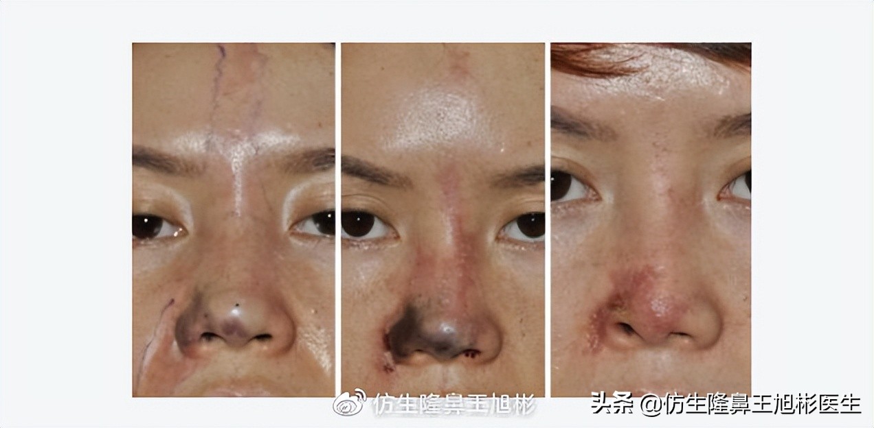 短鼻蒜头鼻整形,短鼻延长术切口